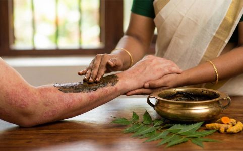 Best way to treat Psoriasis