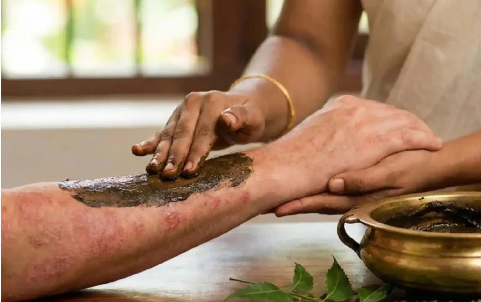 Psoriasis Treatment