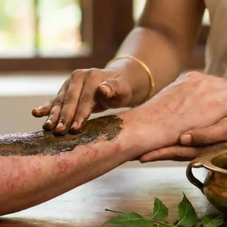 Psoriasis Treatment