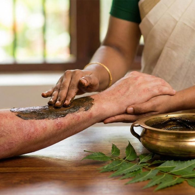Ayurvedic treatment for Psoriasis